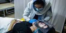 Estetica talebana: a Kabul vanno di moda botox e trapianti