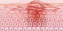 In 3 casi su 4 il melanoma nasce con un nuovo neo. Il metodo “ABCDE” per riconoscerlo