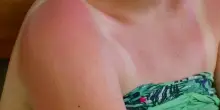 Melanoma, studio Iqvia: meno di un italiano su 4 controlla i nei