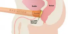 Al San Carlo di Potenza innovazione nella radioterapia carcinoma prostata