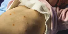 Morbillo, quali sono i sintomi e cosa fare se si &egrave; stati contagiati