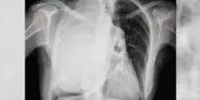 Pensava fosse scoliosi, ma era un tumore da 3,5 kg: operata a Bari