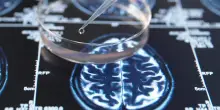 Cure per la fibrillazione atriale utili contro l'Alzheimer: lo studio