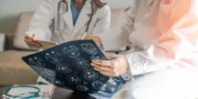 Ictus cerebrale, come prevenirlo e come riconoscere i primi segnali