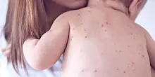 Morbillo, allarme Ministero per rischio di aumento dei casi in Italia