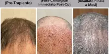 Trapianto di capelli e tricologia avanzata: perch&eacute; il protocollo integrato fa la differenza