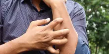 Studio Novartis, l'orticaria cronica spontanea costa 4.200 euro l'anno a paziente