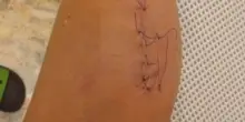 Ferita con una bottiglia rotta da uno straniero fuori di testa. &Egrave; ancora libero