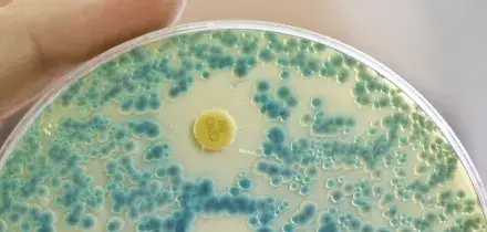 Che cos&rsquo;&egrave; la meningite tubercolare che ha colpito la bimba ricoverata a Bologna