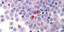 Tumore del colon-retto, la strategia che colpisce le cellule resistenti