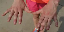 Orticaria cronica spontanea, i costi e l&rsquo;impatto sulla vita quotidiana
