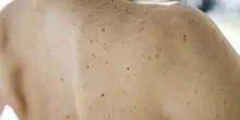 Il cerotto che sfrutta la luce per curare le ferite della pelle