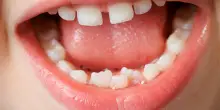 Prevenzione dentale e sorriso, ecco come stanno gli italiani