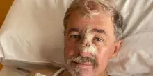Marco Bucci e il basalioma, alla scoperta di un tumore della pelle meno noto