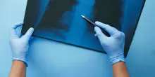 Nodulo al polmone, cosa &egrave; e come si cura