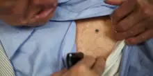 Melanoma, il vaccino a mRna riduce del 42% i rischi di recidiva