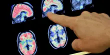 Alzheimer, la stimolazione transcranica a corrente continua potrebbe frenare la crescita delle placche. Lo studio