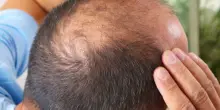 &ldquo;Prima era solo un sospetto, ora c&rsquo;&egrave; la conferma. Ozempic, Wegovy e i farmaci dimagranti aumentano la perdita dei capelli, soprattutto negli uomini gi&agrave; predisposti all&rsquo;alopecia&rdquo;: il nuovo studio