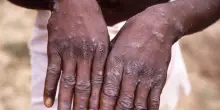 Vaiolo delle scimmie, l&rsquo;Oms: &ldquo;&Egrave; ancora un&rsquo;emergenza&rdquo;. Il virus Mpox circola anche in Italia, preoccupa la trasmissione per via sessuale