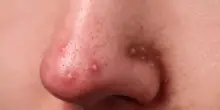 &ldquo;Via l&rsquo;acne, capelli splendenti e seno pi&ugrave; voluminoso&rdquo;: cos&rsquo;&egrave; lo spironolattone, il farmaco che spopola su TikTok, e perch&eacute; non va assunto come una &ldquo;pillola magica che cambia la vita&rdquo;