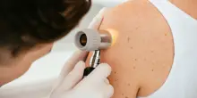 “Bisogna sempre evitare le scottature, quando mettete la crema solare non dimenticatevi di questi punti”: i consigli della dermatologa nella Giornata europea per la prevenzione del melanoma
