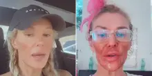 “Ho usato la crema depilatoria per un parassita e mi sono ustionata. Ho esagerato io”: Brandi Glanville si mostra su TikTok. Ma c’è chi le dice: “Eccessivo filler”