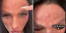 “Mi sono spuntate delle gobbe sulla fronte”: Katie Price mostra il suo viso dopo il trattamento con il botox