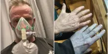 &ldquo;Tutti al pronto soccorso mi fissavano come se avessero visto un fantasma&rdquo;. L&rsquo;incredibile caso dell&rsquo;uomo che si &egrave; risvegliato la mattina con il corpo tutto blu