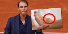 &ldquo;Dicevano che non avrei mai pi&ugrave; giocato. Non era solo una piccola crepa, &egrave; una malattia&rdquo;: la foto del piede deformato di Nadal. Cos&rsquo;&egrave; la sindrome di M&uuml;ller-Weiss