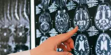 Un malato di Sla con paralisi e difficolt&agrave; nel parlare comunica da due anni nella vita di tutti i giorni grazie a un chip impiantato nel cervello