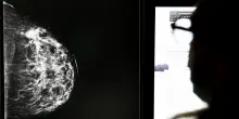 Cos&igrave; il &ldquo;branco&rdquo; delle cellule rendono il tumore al seno pi&ugrave; aggressivo, ma anche pi&ugrave; intercettabile. Lo studio