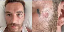 &ldquo;Purtroppo io, come tanti, ho messo le creme solari e il risultato &egrave; il cancro della pelle. Carcinoma basocellulare&rdquo;: parla Salmo