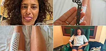 Brignone mostra il ginocchio operato e la placca rimossa, poi rassicura: &ldquo;Sto bene, avr&ograve; qualche giorno in stampelle&rdquo;