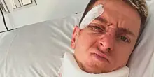 La foto di Pogacar dall&rsquo;ospedale dopo la caduta: deve operarsi, stagione a rischio. Come sta