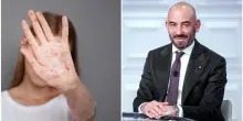 &ldquo;Siamo solo all&rsquo;inizio di una gravissima epidemia&rdquo;: Matteo Bassetti lancia l&rsquo;allarme dopo il boom di casi di morbillo in Italia