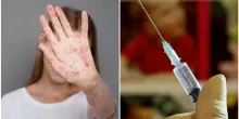 &ldquo;Ridurre le vaccinazioni contro il morbillo pu&ograve; aprire la strada a epidemie molto estese&rdquo;, l&rsquo;infettivologo e lo studio Usa sul rischio di decessi pediatrici