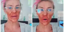 Crema depilatoria in faccia per uccidere un parassita: la modella Brandi Glanville resta sfigurata. Il video senza filtri