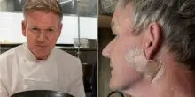Gordon Ramsay scopre un tumore alla pelle sul collo: «Mi sono operato, usate sempre la crema solare». E mostra la cicatrice