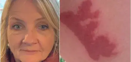 Passeggera risarcita da Ryanair per le gravi ustioni causate dal caff&egrave; bollente caduto sulle sue gambe