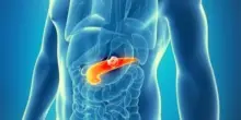 Tumore al Pancreas, ecco il nuovo farmaco approvato dall'Aifa (ma solo per alcuni pazienti)