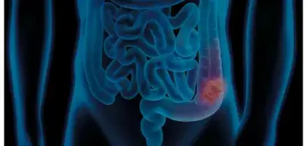 Tumore al colon retto, dai sintomi alla dieta: i 10 alimenti fondamentali per prevenirlo. La nutrizionista: &laquo;Bisogna mangiarli tutti i giorni&raquo;