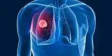 Tumore ai polmoni, scoperto nuovo meccanismo di resistenza all?immunoterapia: lo studio italiano