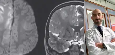 &laquo;Ecco cosa ha fatto il morbillo al cervello di un bambino che lo ha avuto a 7 mesi&raquo;. L'allarme di Bassetti