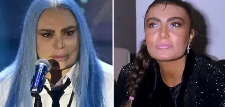 Loredana Bert&eacute;, prima e dopo: com'&egrave; cambiata dagli esordi a oggi. Filler, botox, blefaroplastica? I dubbi sui ritocchini