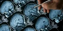 Alzheimer, ecco i segnali del linguaggio che preannunciano il declino cognitivo