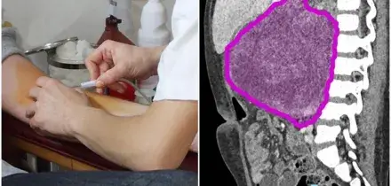 Tumori, un test del sangue &laquo;low cost&raquo; promette di rilevare pi&ugrave; tipi di patologie: la tecnica del ?rumore di fondo?