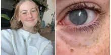 &laquo;A 20 anni sono diventata cieca dopo aver fatto la doccia con le lenti a contatto per un'infezione, ora vedo solo un alone bianco&raquo;