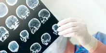 Alzheimer, cure pi&ugrave; vicine? Scoperta proteina (Sox9) che riaccende le cellule spazzine del cervello