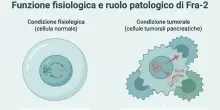 Tumore al pancreas, ecco perch&eacute; resiste ai farmaci: scoperta la proteina che rende le cure inefficaci