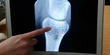 Osteoporosi, le donne che ne soffrono hanno il 50% di probabilit&agrave; in pi&ugrave; di morire prematuramente: come prevenire la patologia
